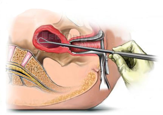 Endometrial Biyopsi